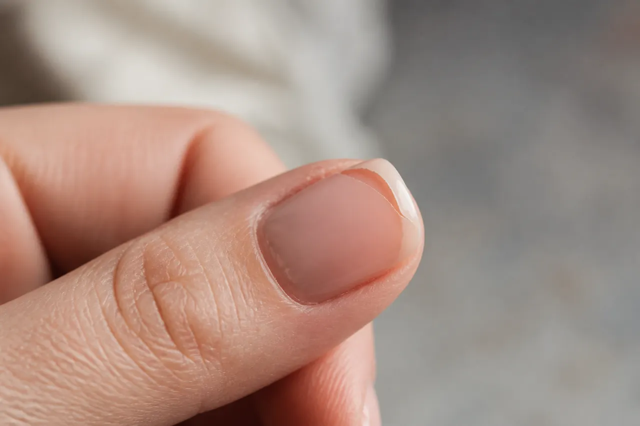 Décollement d'un vernis semi-permanent sur un ongle